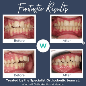 Patient orthodontics before and after image 4