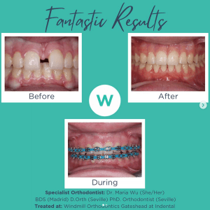 Patient orthodontics before and after image 0