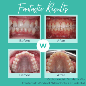 Patient orthodontics before and after image 2