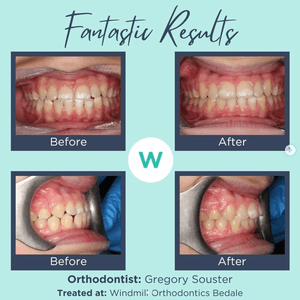 Patient orthodontics before and after image 1