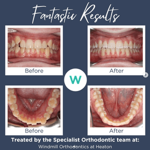 Patient orthodontics before and after image 5