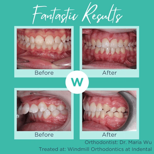 Patient orthodontics before and after image 3