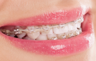 An orthodontics patient with braces