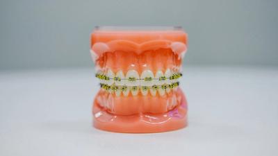 A model of a mount and teeth with fixed braces